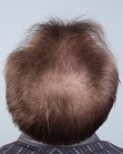 Before Hair Transplant&nbsp;2 Sessions (Areas)